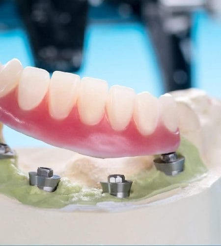 implant supported overdentures